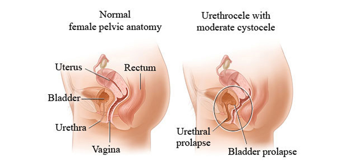 Urethral Stricture Surgery