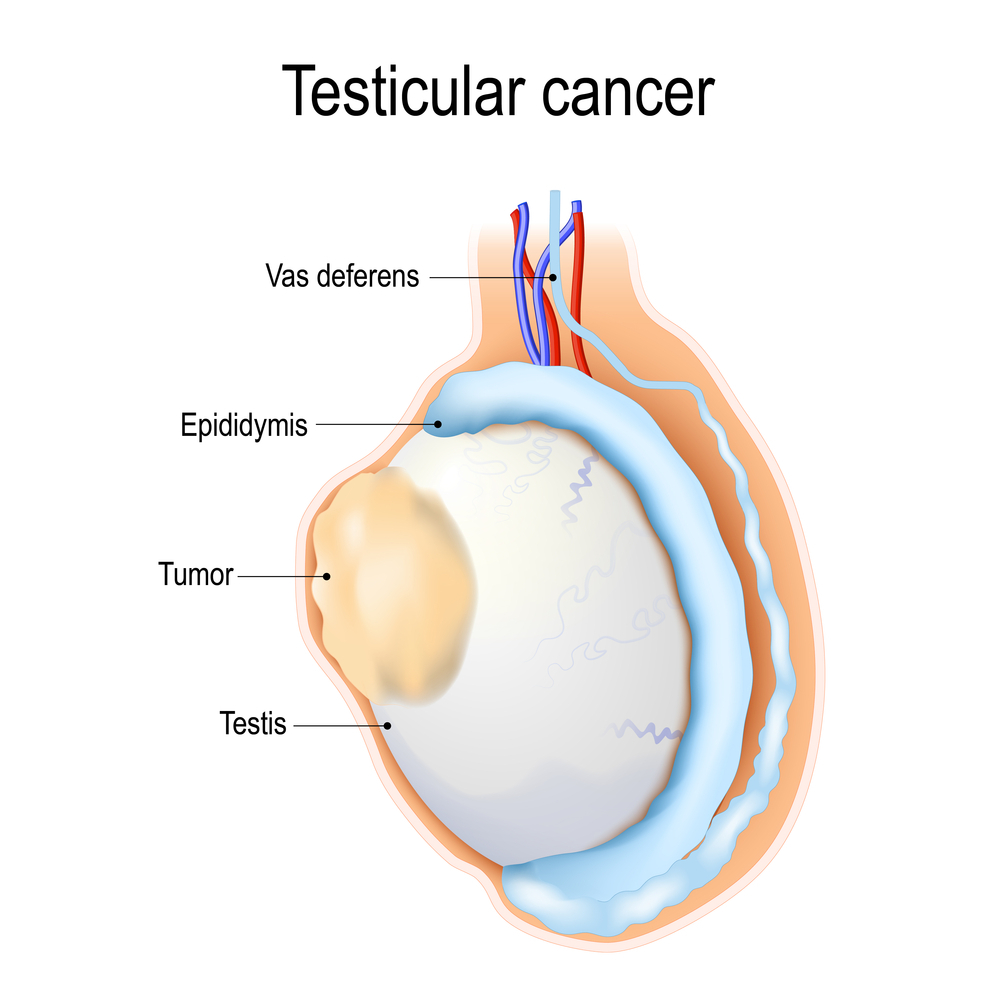 Symptoms Of Testicular Cancer Testicular Cancer Symptoms And Signs Symptoms Of Testicular Cancer Testicular Cancer Symptoms And Signs