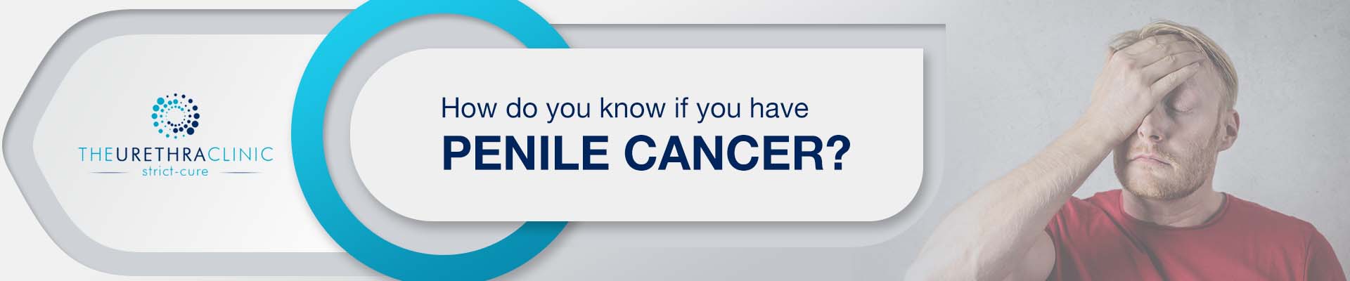 How To Know If You Have Penile Cancer