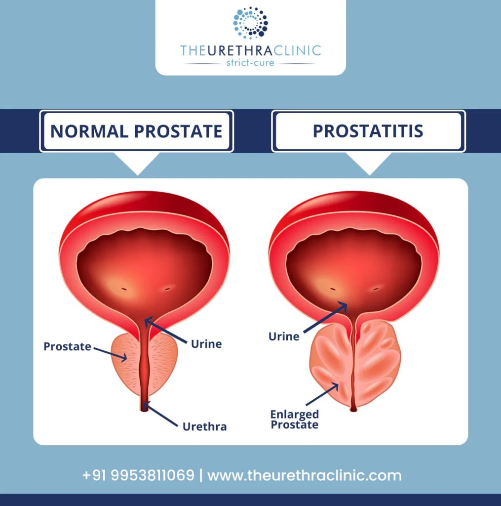 Normal Prostate vs Prostatitis