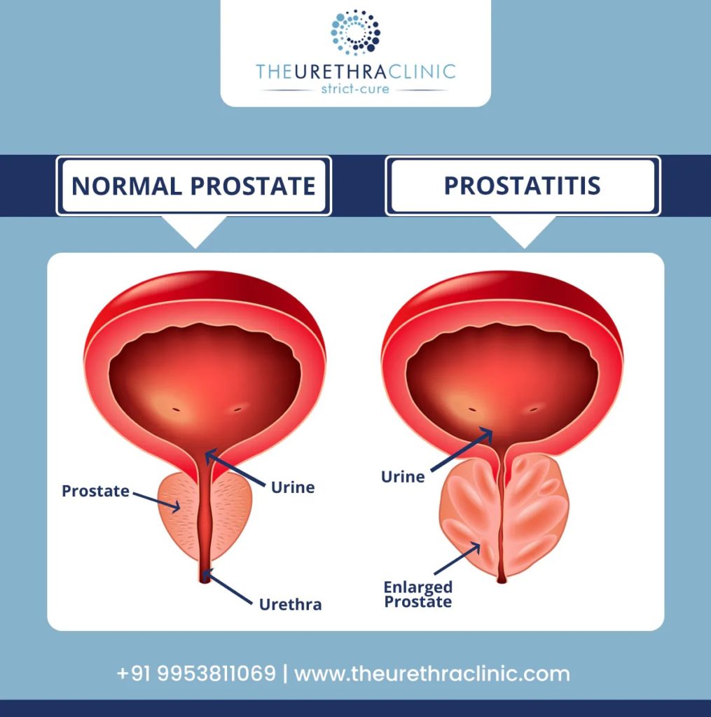 Prostatitis Symptoms Causes Diagnosis Treatment And Risks 