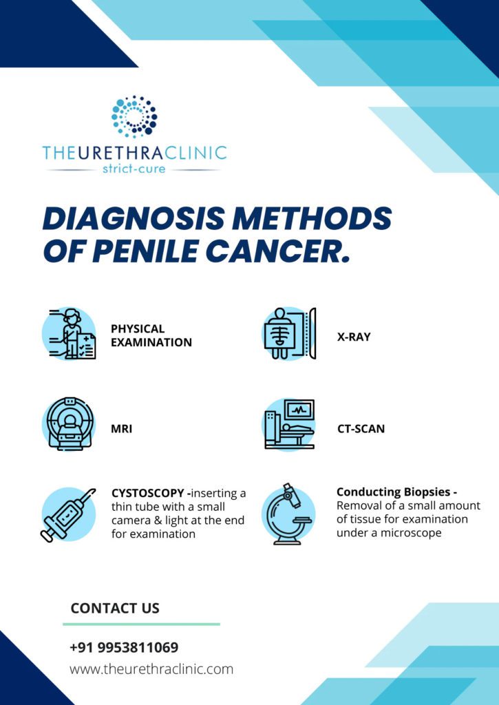 Diagnosis method of penile cancer