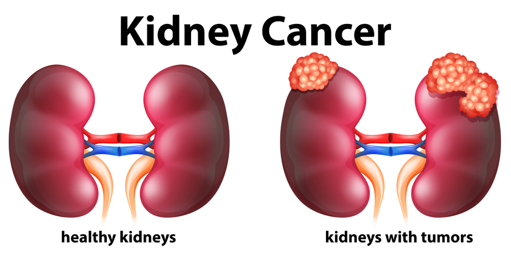 Kidney Cancer Treatment & Specialist in Delhi NCR